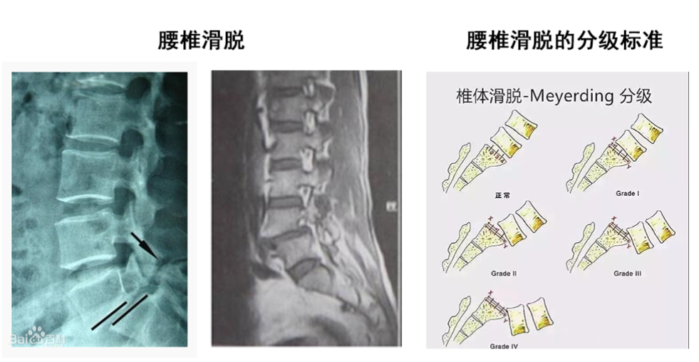人工智能滑脱的分级